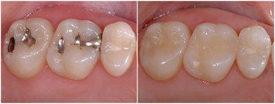 White Fillings