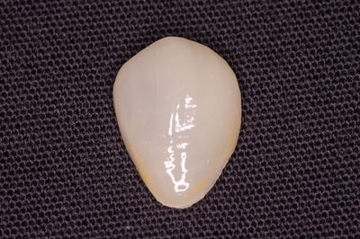 Porcelain Veneers