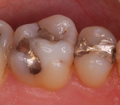 Amalgam Fillings